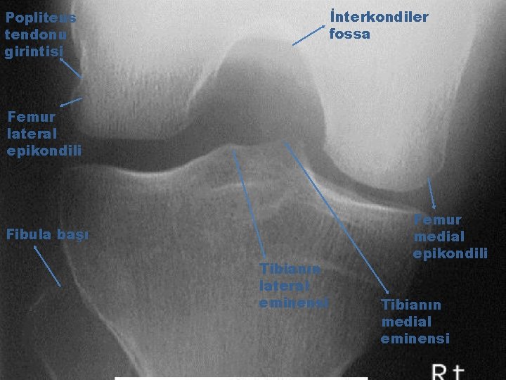 İnterkondiler fossa Popliteus tendonu girintisi Femur lateral epikondili Fibula başı Tibianın lateral eminensi Femur