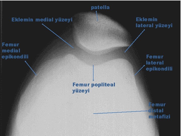 patella Eklemin medial yüzeyi Femur medial epikondili Eklemin lateral yüzeyi Femur lateral epikondili Femur