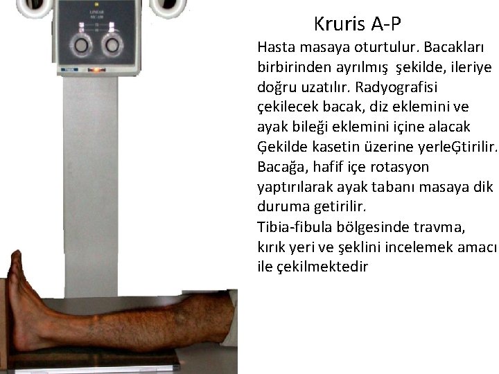 Kruris A-P Hasta masaya oturtulur. Bacakları birbirinden ayrılmış şekilde, ileriye doğru uzatılır. Radyografisi çekilecek