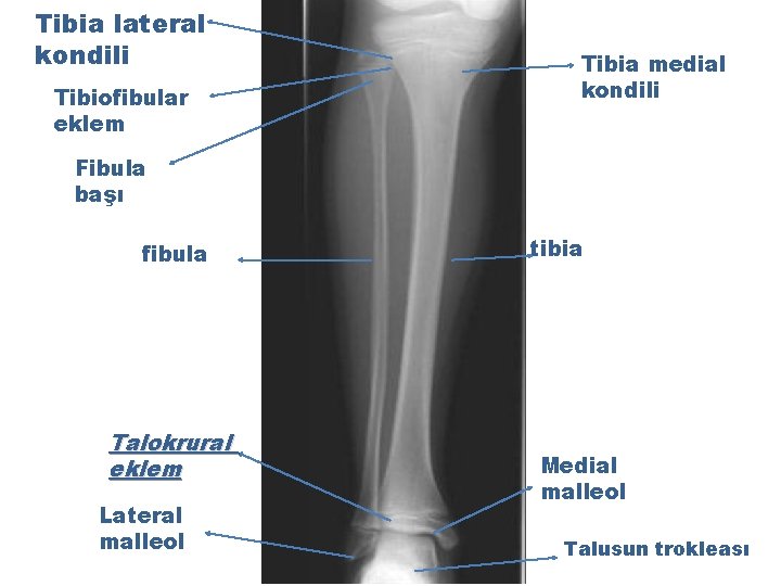 Tibia lateral kondili Tibiofibular eklem Tibia medial kondili Fibula başı fibula Talokrural eklem Lateral