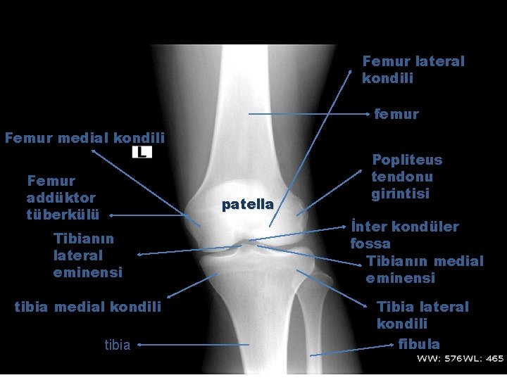 Femur lateral kondili femur Femur medial kondili Femur addüktor tüberkülü patella Tibianın lateral eminensi