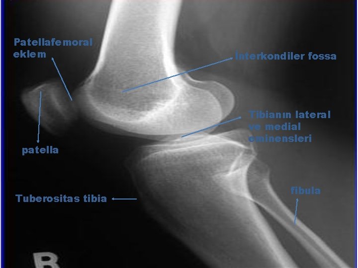 Patellafemoral eklem patella Tuberositas tibia İnterkondiler fossa Tibianın lateral ve medial eminensleri fibula 