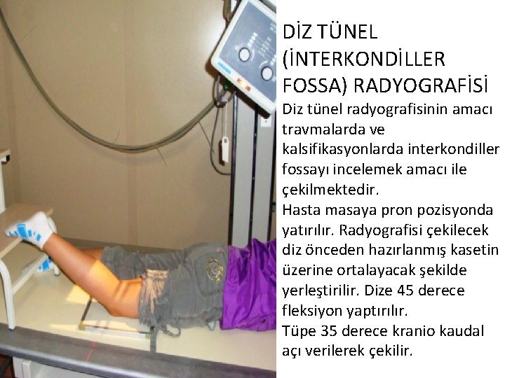 DİZ TÜNEL (İNTERKONDİLLER FOSSA) RADYOGRAFİSİ Diz tünel radyografisinin amacı travmalarda ve kalsifikasyonlarda interkondiller fossayı