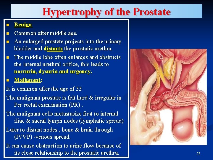 Hypertrophy of the Prostate Benign n Common after middle age. n An enlarged prostate