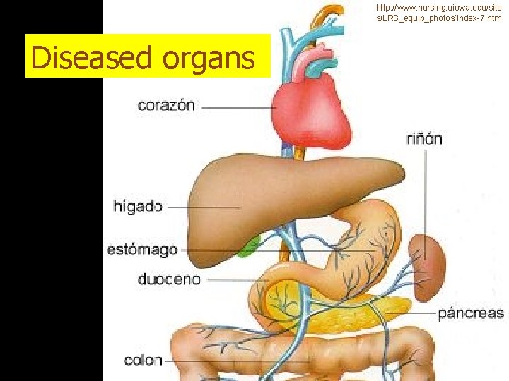 http: //www. nursing. uiowa. edu/site s/LRS_equip_photos/Index-7. htm Diseased organs 