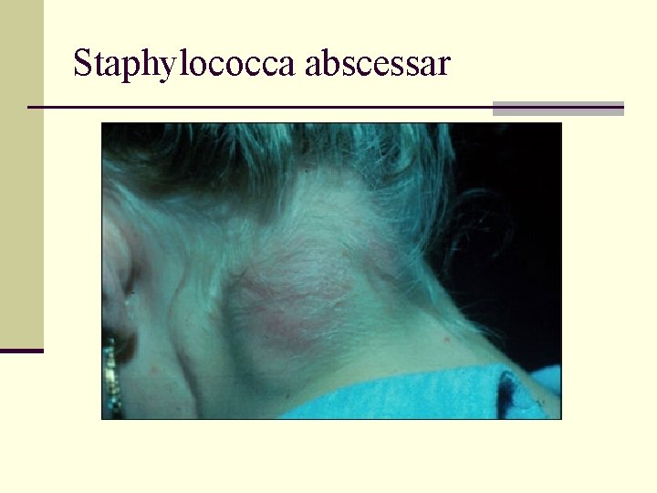 Staphylococca abscessar 