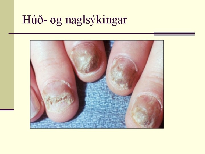 Húð- og naglsýkingar 