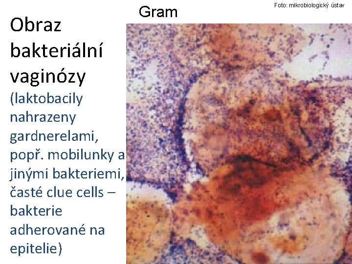 Obraz bakteriální vaginózy (laktobacily nahrazeny gardnerelami, popř. mobilunky a jinými bakteriemi, časté clue cells