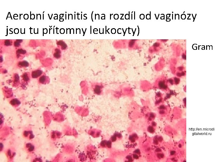 Aerobní vaginitis (na rozdíl od vaginózy jsou tu přítomny leukocyty) Gram http: //en. microdi