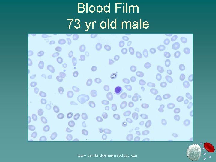 Blood Film 73 yr old male www. cambridgehaematology. com 