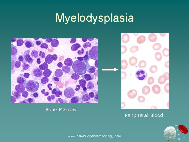 Myelodysplasia Bone Marrow www. cambridgehaematology. com Peripheral Blood 