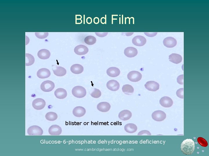 Blood Film blister or helmet cells Glucose-6 -phosphate dehydrogenase deficiency www. cambridgehaematology. com 