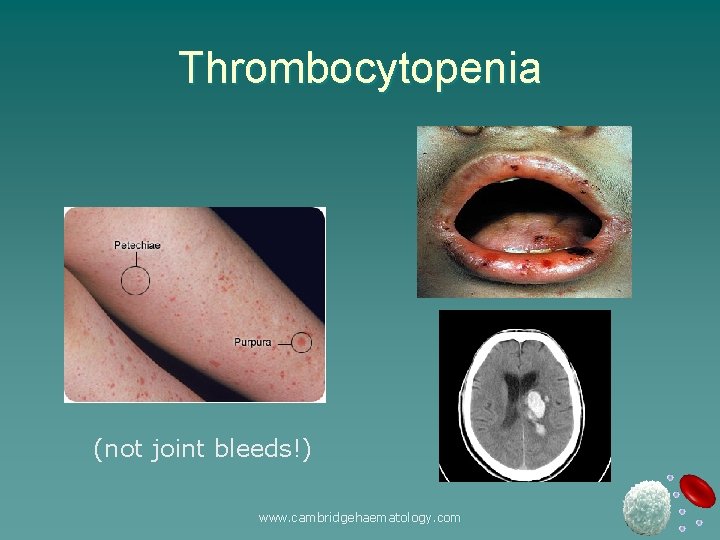 Thrombocytopenia (not joint bleeds!) www. cambridgehaematology. com 