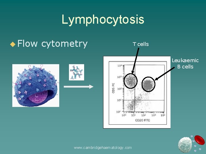 Lymphocytosis u Flow cytometry T cells Leukaemic B cells www. cambridgehaematology. com 