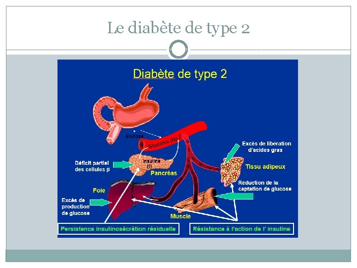 Le diabète de type 2 