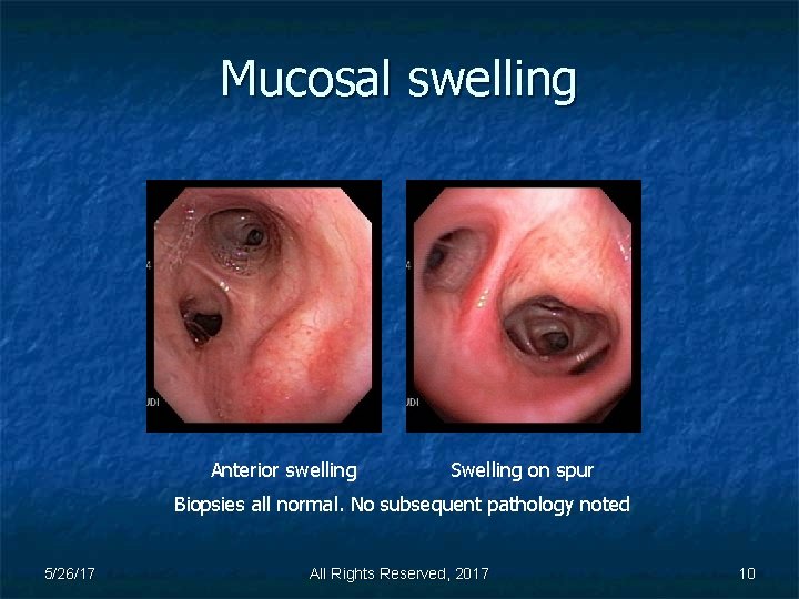 Mucosal swelling Anterior swelling Swelling on spur Biopsies all normal. No subsequent pathology noted