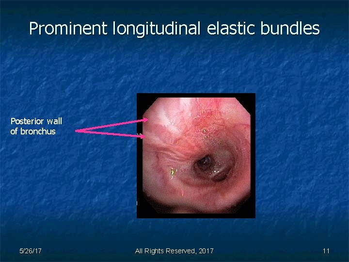 Prominent longitudinal elastic bundles Posterior wall of bronchus 5/26/17 All Rights Reserved, 2017 11