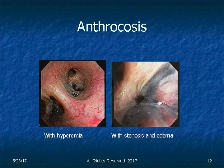 Anthrocosis With hyperemia 5/26/17 With stenosis and edema All Rights Reserved, 2017 12 
