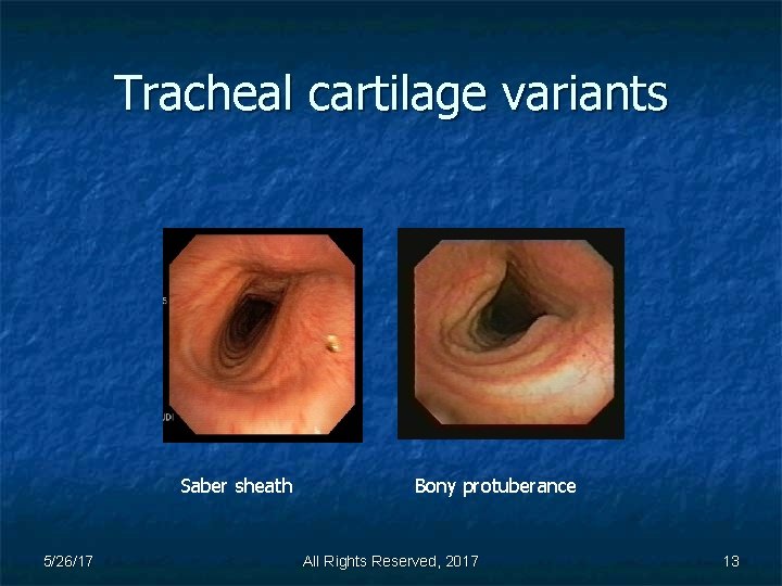 Tracheal cartilage variants Saber sheath 5/26/17 Bony protuberance All Rights Reserved, 2017 13 