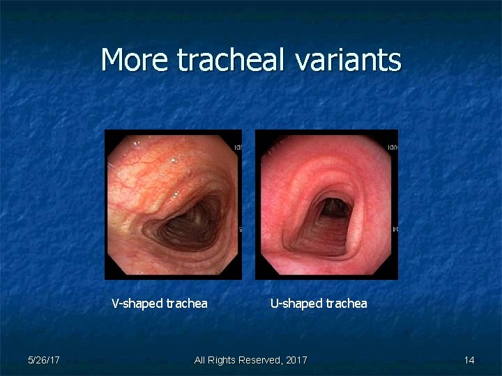 More tracheal variants V-shaped trachea 5/26/17 U-shaped trachea All Rights Reserved, 2017 14 