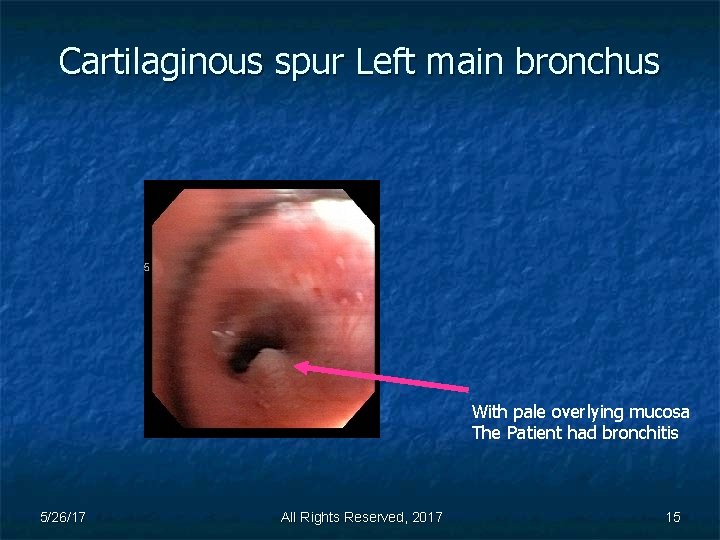 Cartilaginous spur Left main bronchus With pale overlying mucosa The Patient had bronchitis 5/26/17