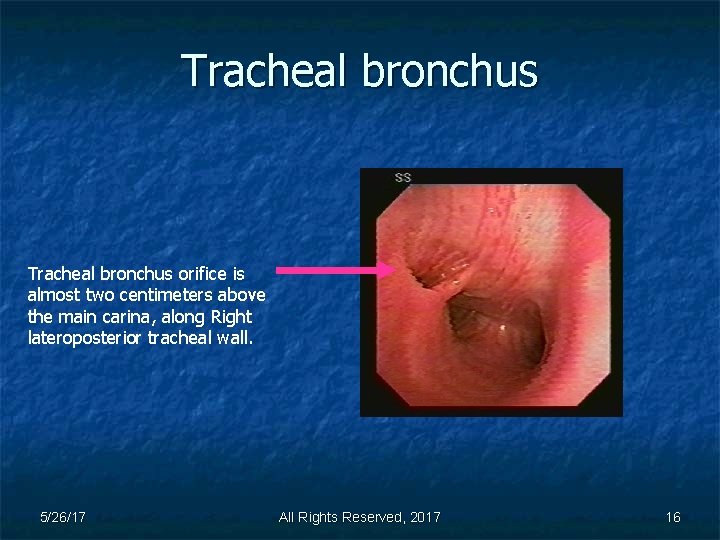 Tracheal bronchus orifice is almost two centimeters above the main carina, along Right lateroposterior
