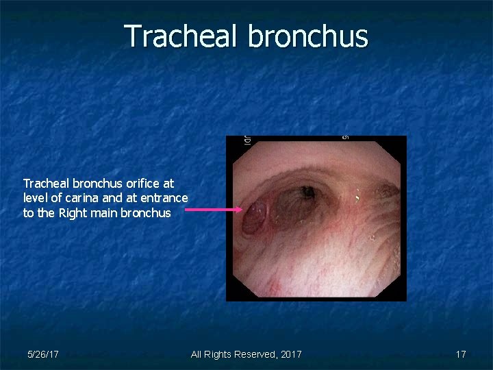 Tracheal bronchus orifice at level of carina and at entrance to the Right main