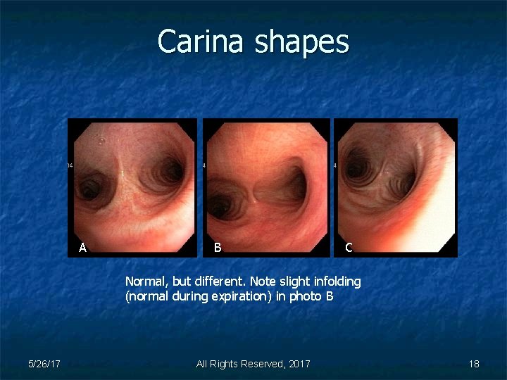 Carina shapes A B C Normal, but different. Note slight infolding (normal during expiration)