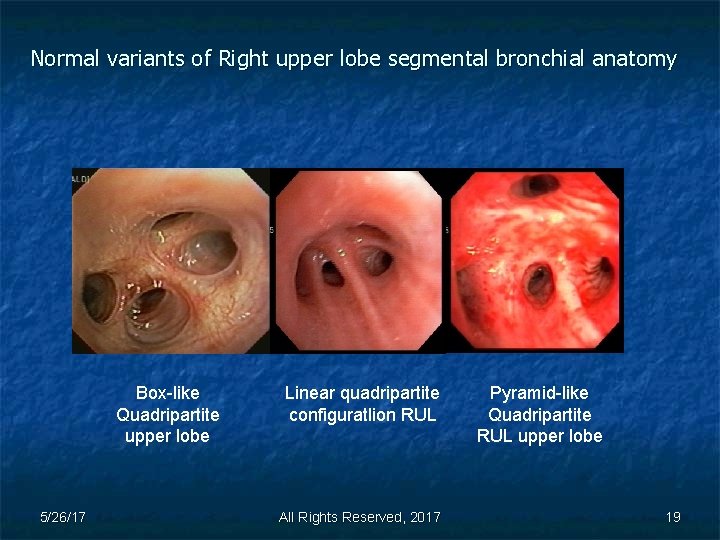 Normal variants of Right upper lobe segmental bronchial anatomy Box-like Quadripartite upper lobe 5/26/17