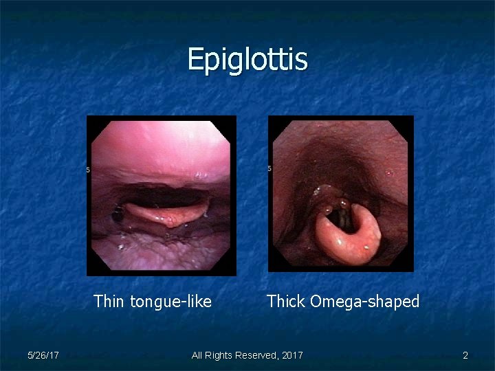 Epiglottis Thin tongue-like 5/26/17 Thick Omega-shaped All Rights Reserved, 2017 2 
