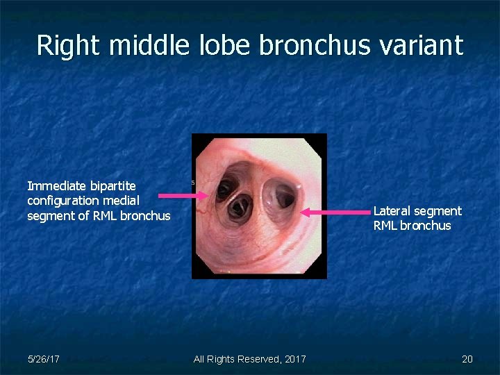 Right middle lobe bronchus variant Immediate bipartite configuration medial segment of RML bronchus 5/26/17