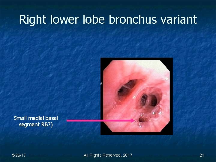 Right lower lobe bronchus variant Small medial basal segment RB 7) 5/26/17 All Rights