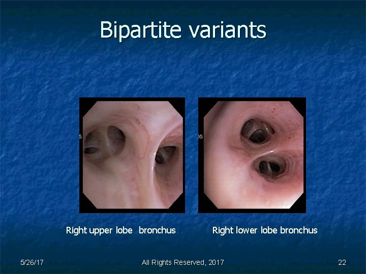 Bipartite variants Right upper lobe bronchus 5/26/17 Right lower lobe bronchus All Rights Reserved,