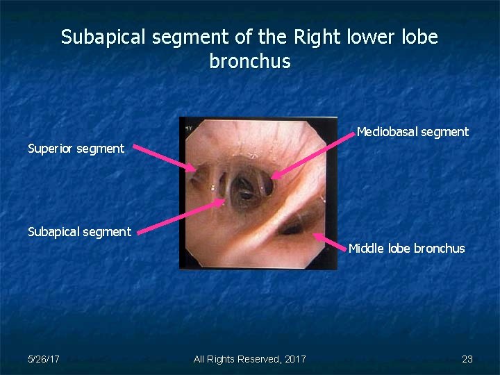 Subapical segment of the Right lower lobe bronchus Mediobasal segment Superior segment Subapical segment