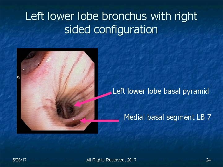 Left lower lobe bronchus with right sided configuration Left lower lobe basal pyramid Medial