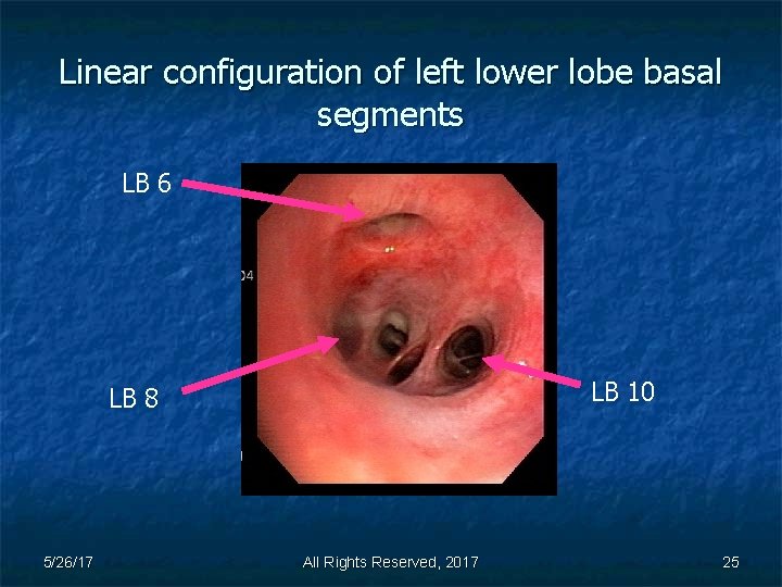 Linear configuration of left lower lobe basal segments LB 6 LB 10 LB 8