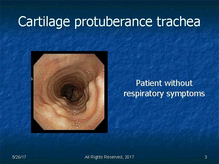 Cartilage protuberance trachea Patient without respiratory symptoms 5/26/17 All Rights Reserved, 2017 3 