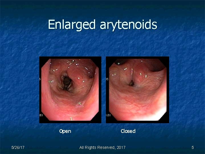 Enlarged arytenoids Open 5/26/17 Closed All Rights Reserved, 2017 5 