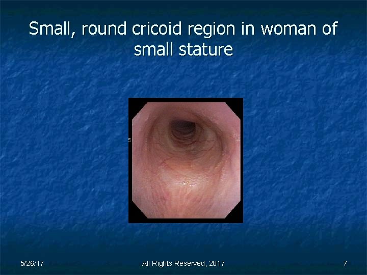 Small, round cricoid region in woman of small stature 5/26/17 All Rights Reserved, 2017