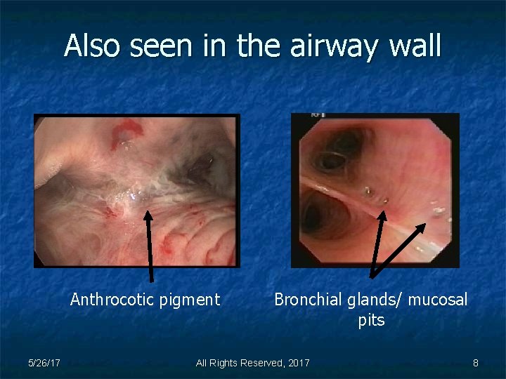 Also seen in the airway wall Anthrocotic pigment 5/26/17 Bronchial glands/ mucosal pits All