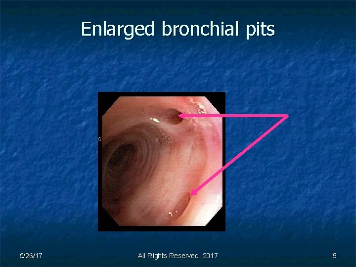 Enlarged bronchial pits 5/26/17 All Rights Reserved, 2017 9 