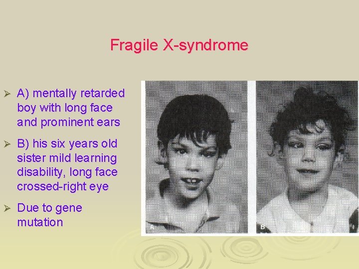 Fragile X-syndrome Ø A) mentally retarded boy with long face and prominent ears Ø