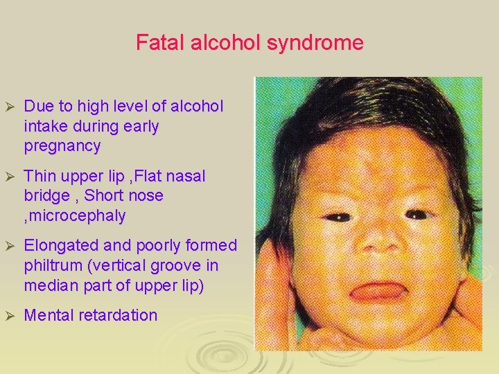Fatal alcohol syndrome Ø Due to high level of alcohol intake during early pregnancy
