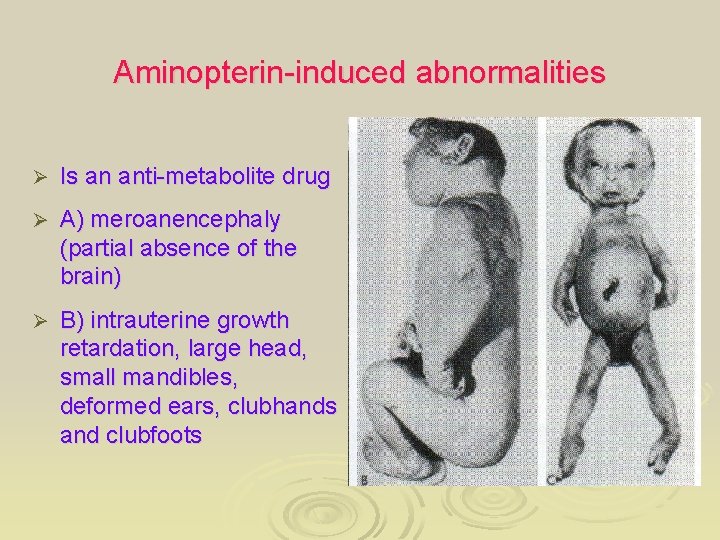Aminopterin-induced abnormalities Ø Is an anti-metabolite drug Ø A) meroanencephaly (partial absence of the