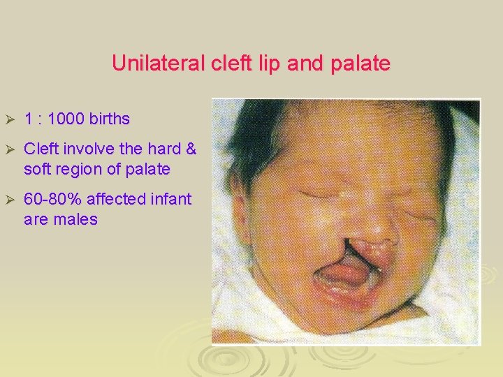 Unilateral cleft lip and palate Ø 1 : 1000 births Ø Cleft involve the