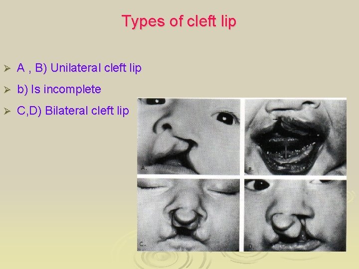 Types of cleft lip Ø A , B) Unilateral cleft lip Ø b) Is
