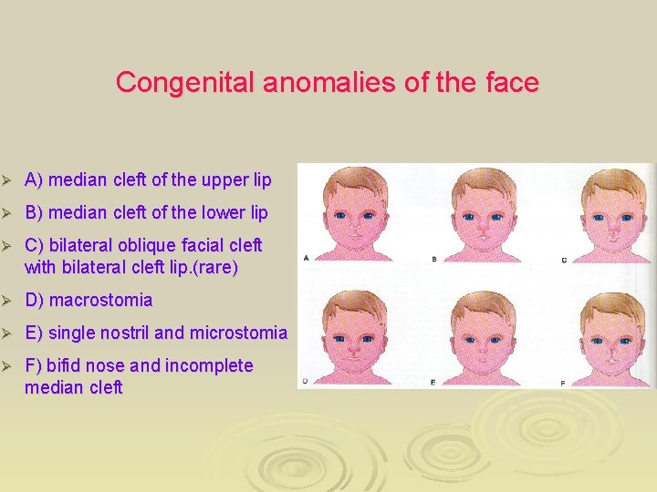 Congenital anomalies of the face Ø A) median cleft of the upper lip Ø