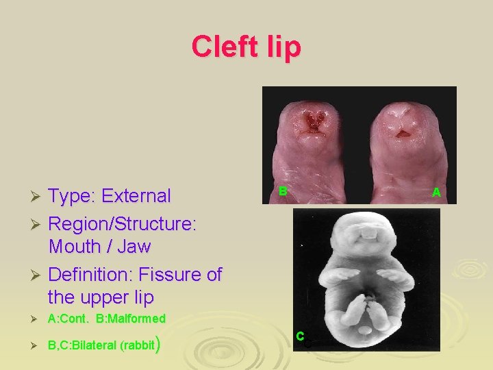 Cleft lip Type: External Ø Region/Structure: Mouth / Jaw Ø Definition: Fissure of the