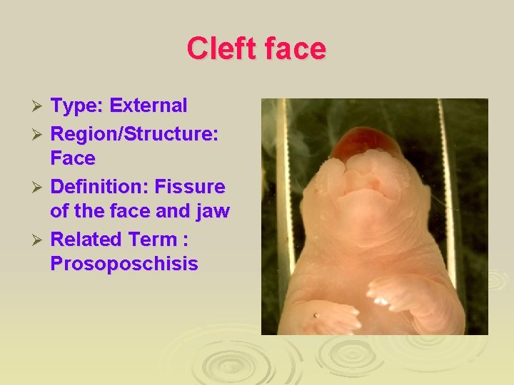 Cleft face Type: External Ø Region/Structure: Face Ø Definition: Fissure of the face and