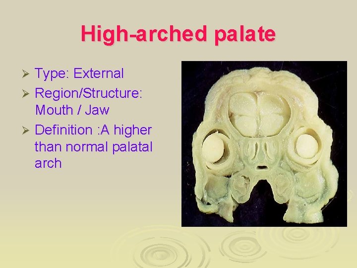 High-arched palate Type: External Ø Region/Structure: Mouth / Jaw Ø Definition : A higher